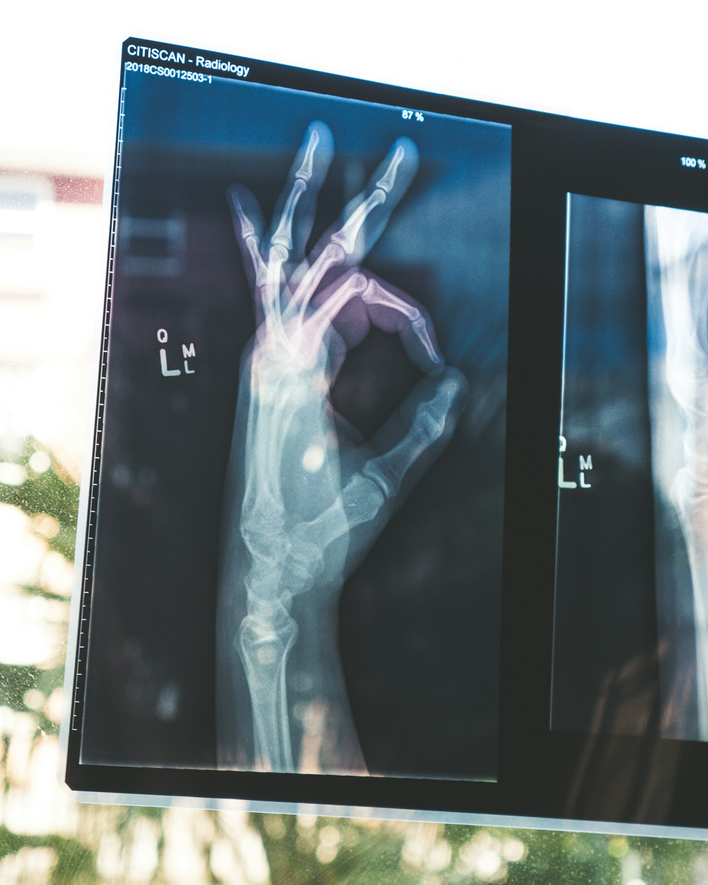 Radiograph of a hand displayed on a clinical monitor